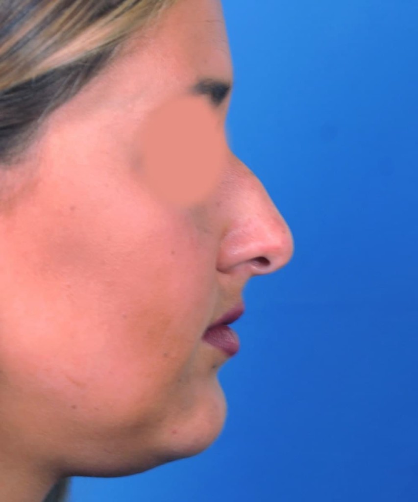 Before lateral