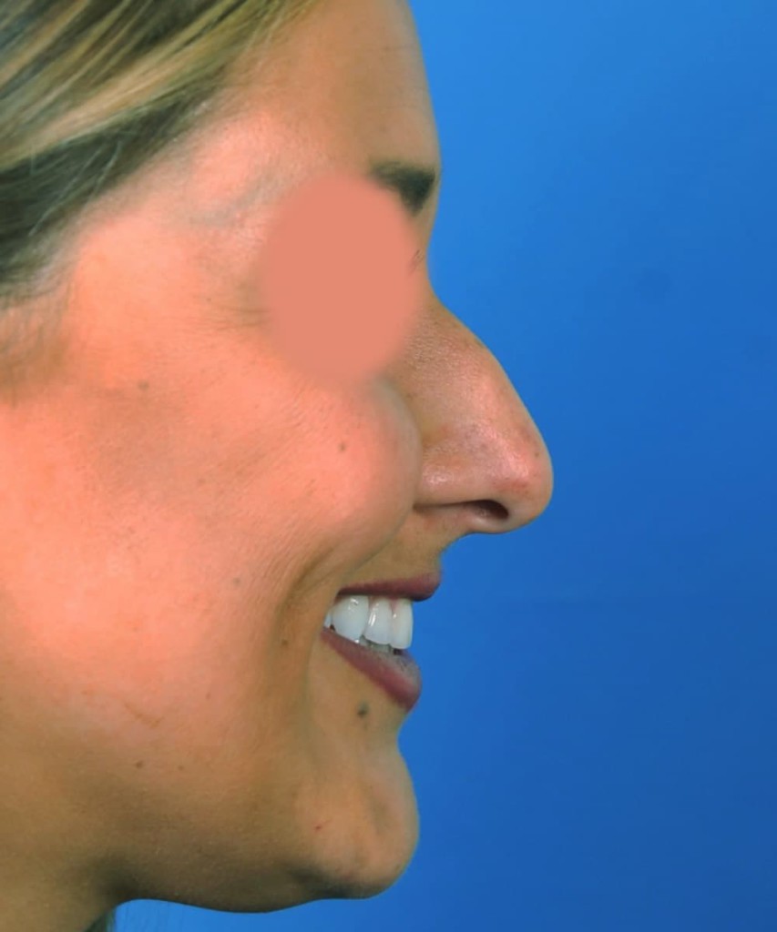 Before smiling