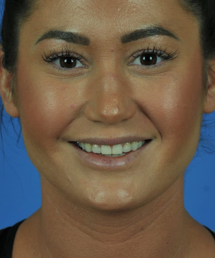 After front smiling