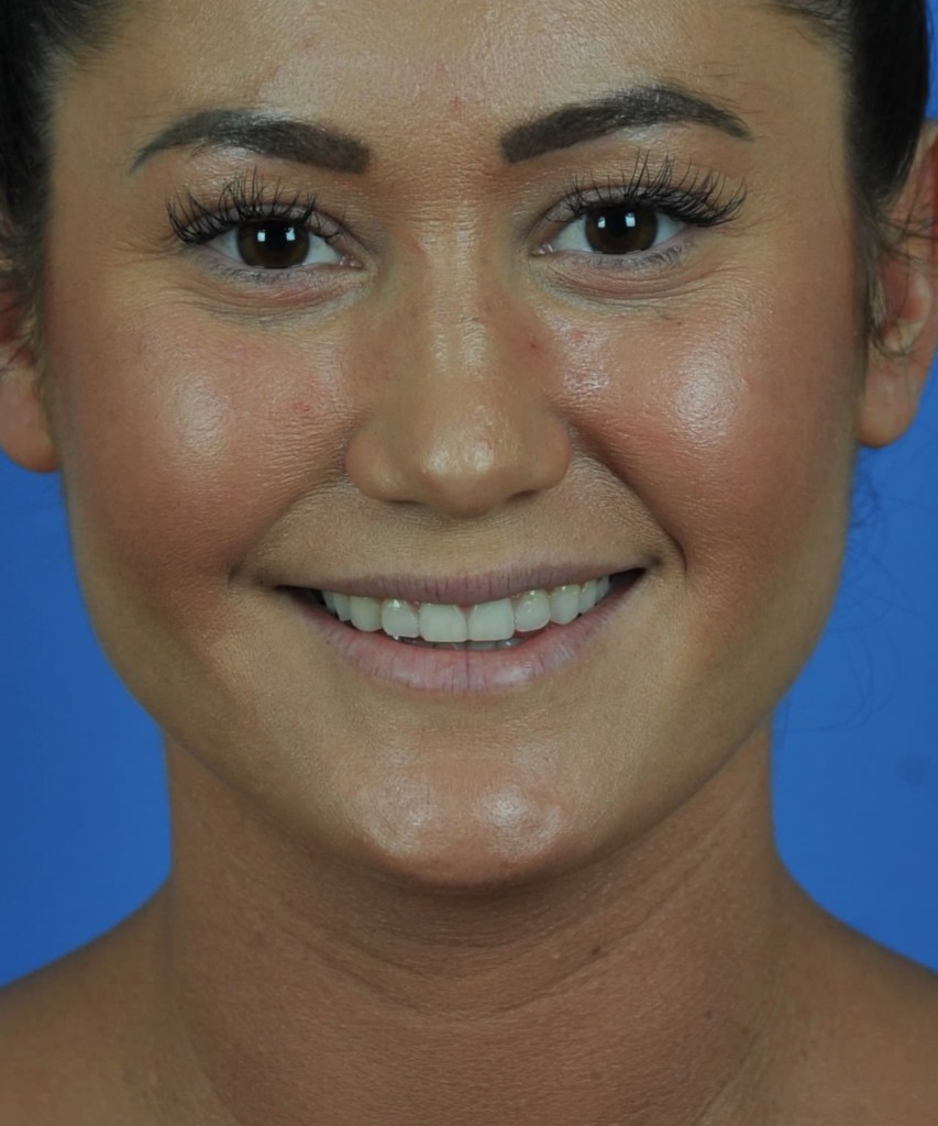 Before front smiling