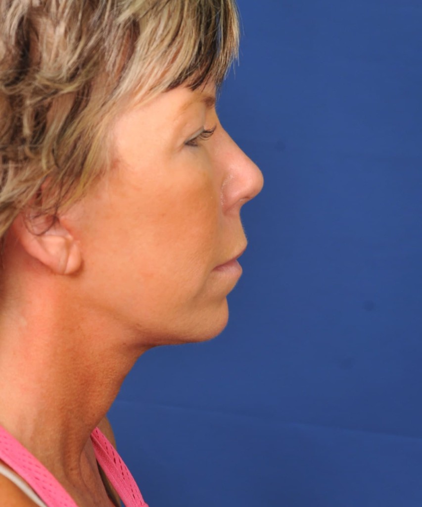 After right lateral