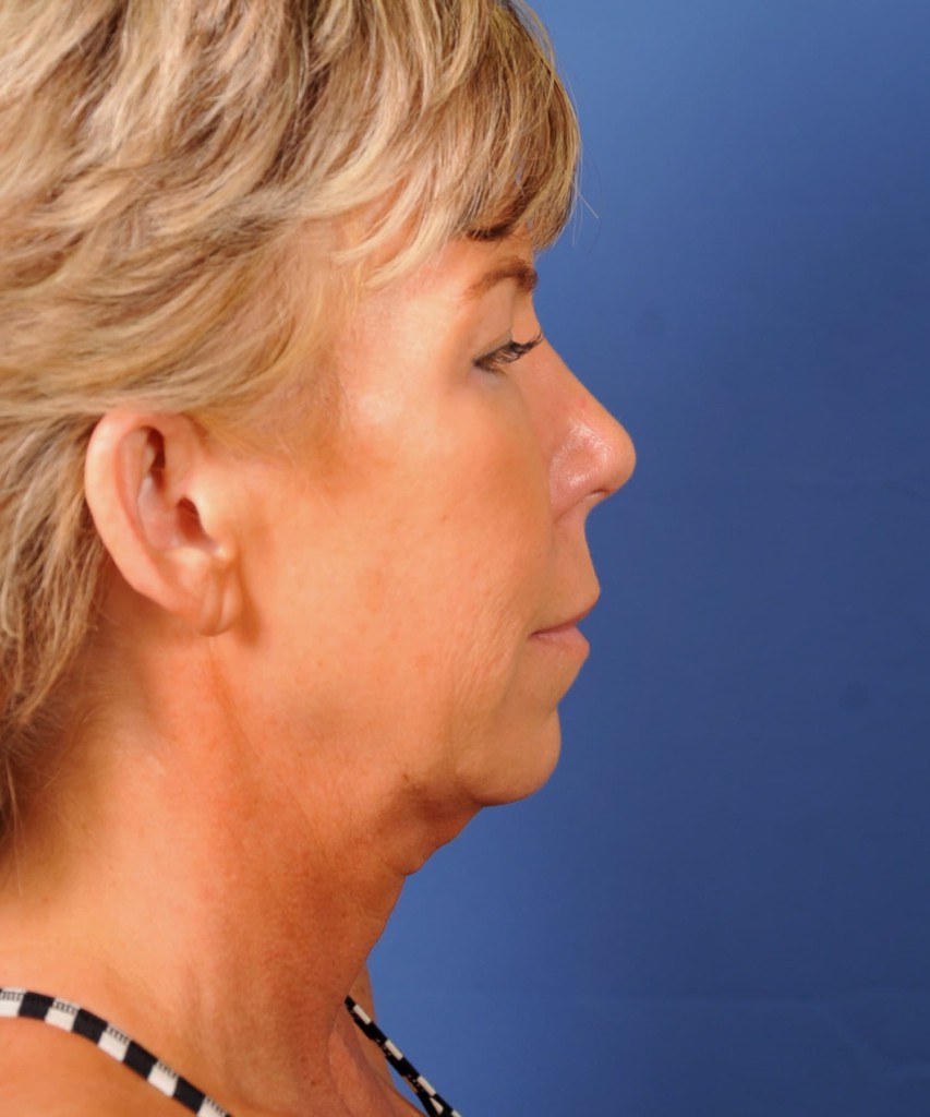 Before right lateral
