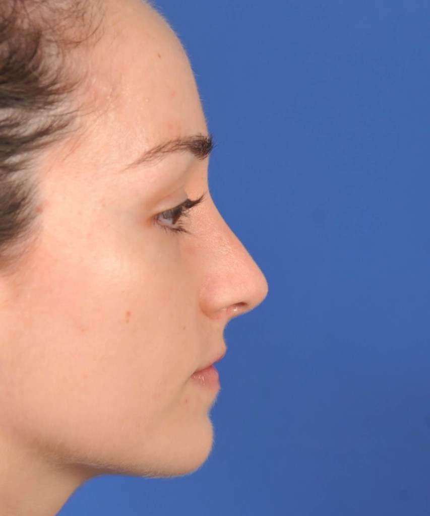 After lateral