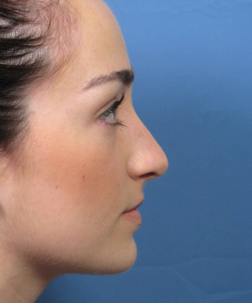 Before lateral