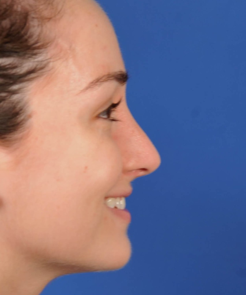 After lateral smiling