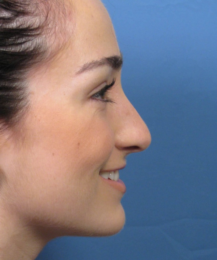 Before lateral smiling