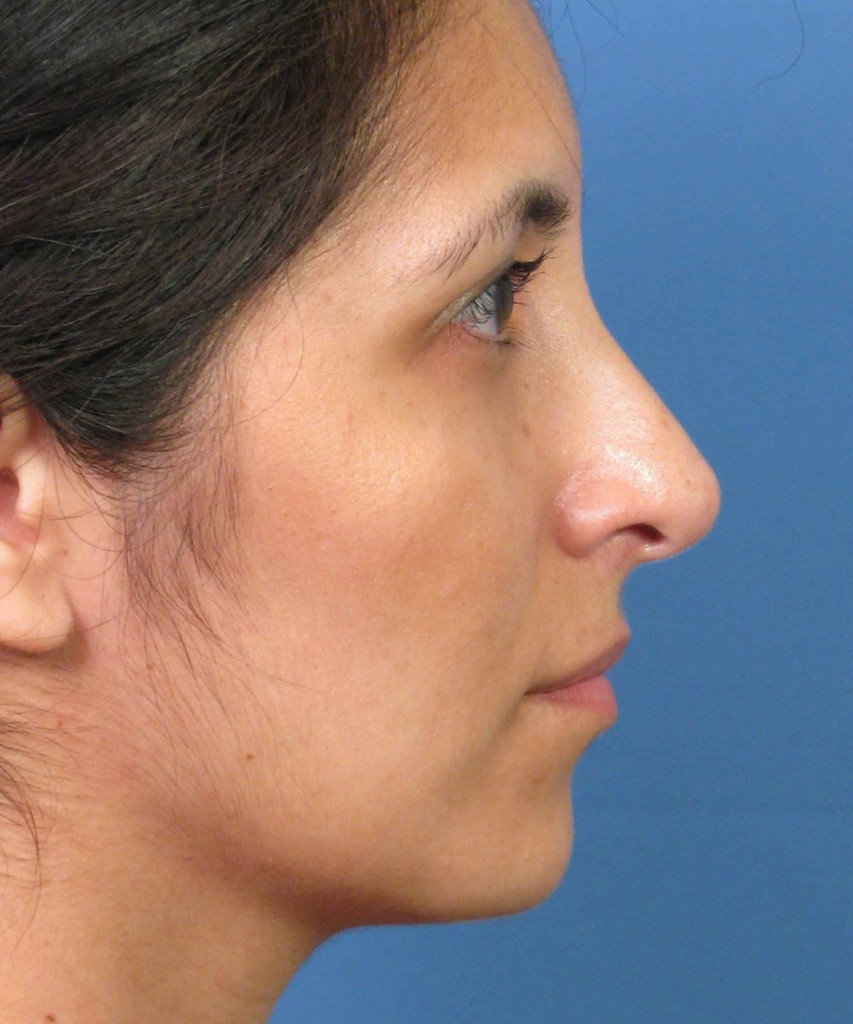 After lateral