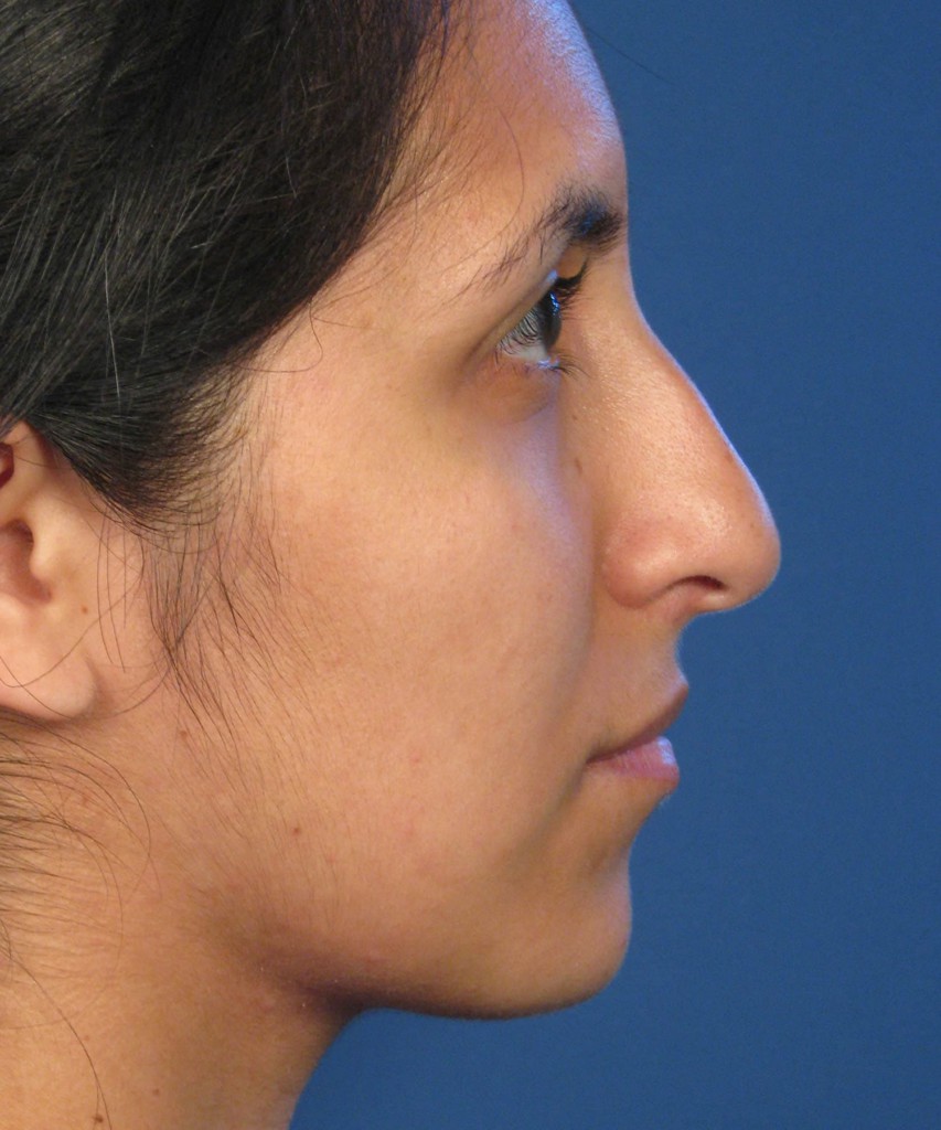 Before lateral