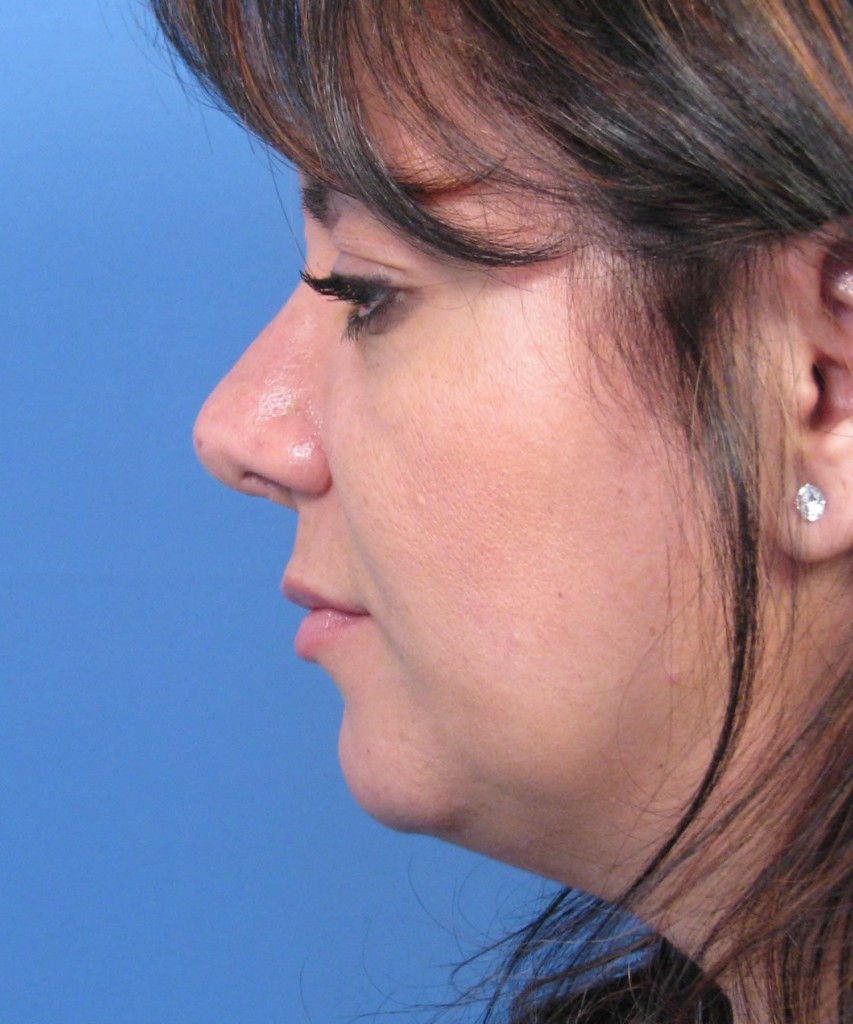 After lateral