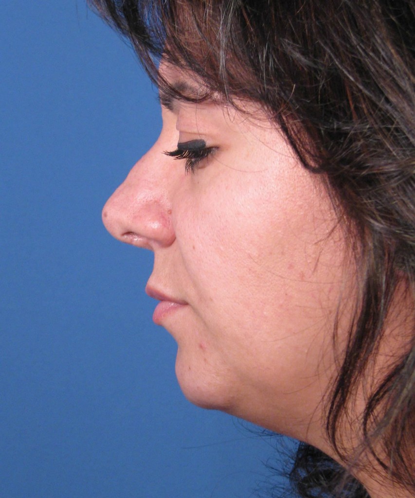 Before lateral