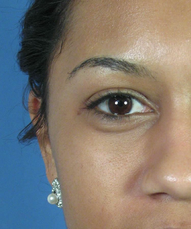 Before frontal
