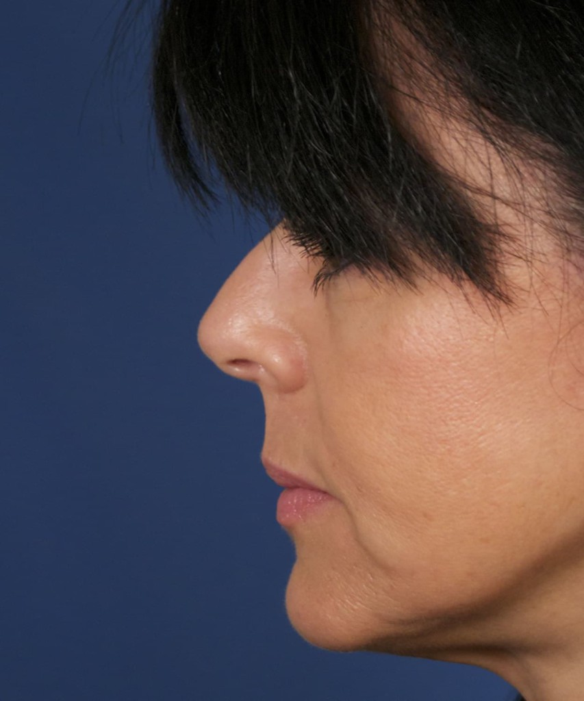 Before lateral