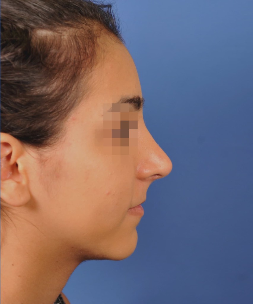 After lateral