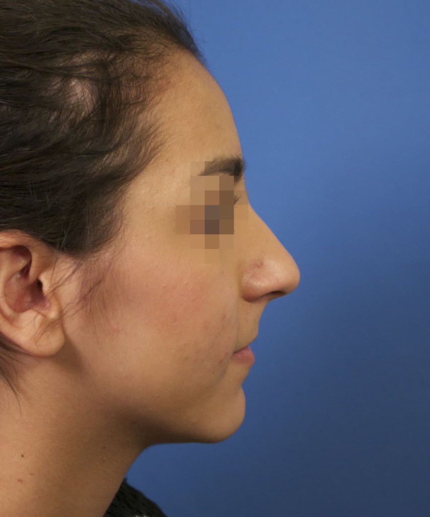 Before lateral
