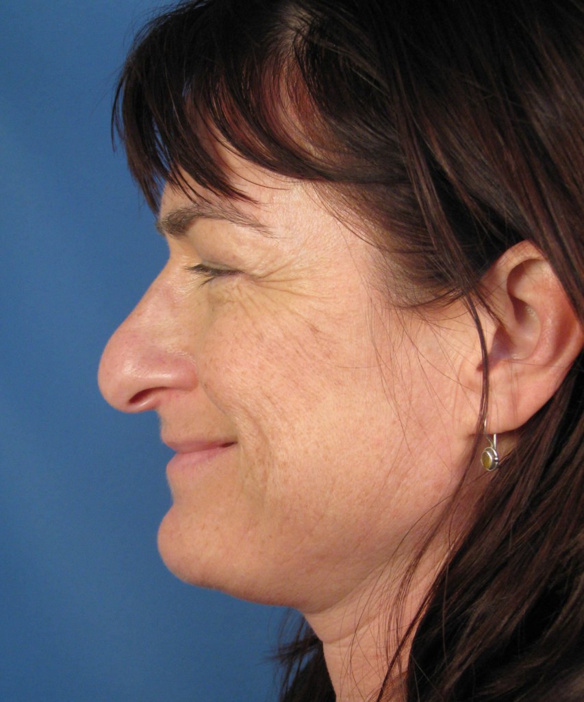 Before side smiling