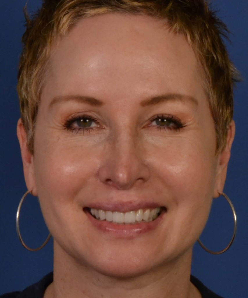 After front smiling
