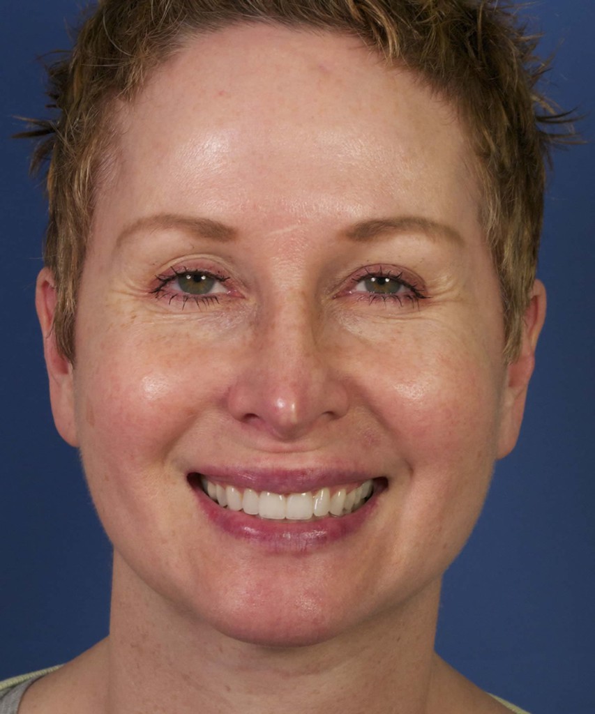 Before front smiling