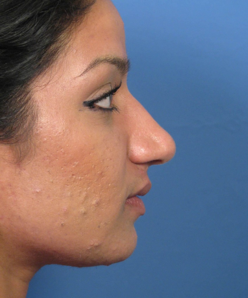 Before lateral