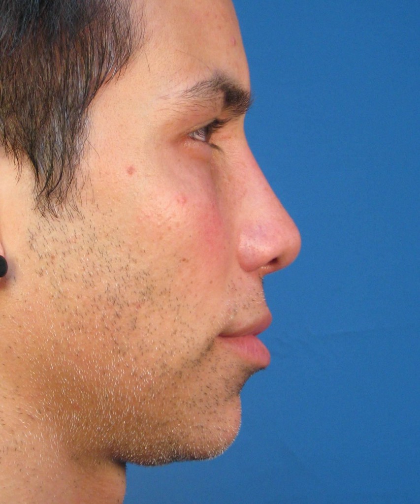 After lateral