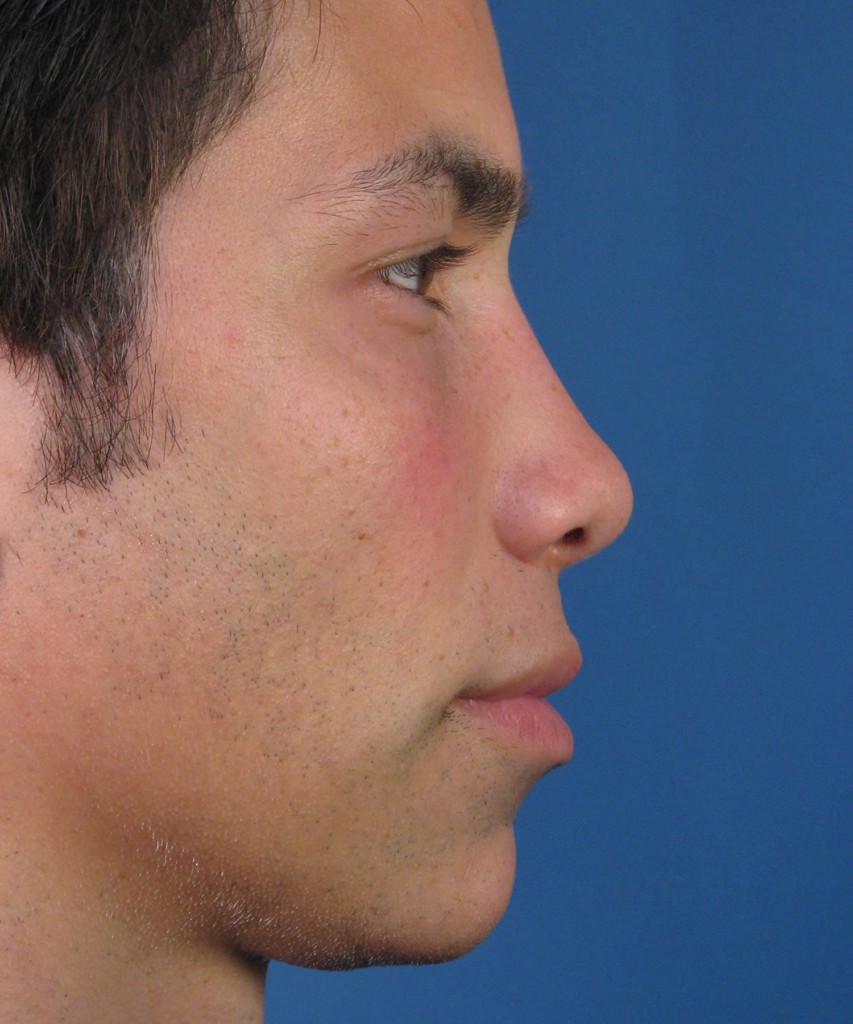 Before lateral