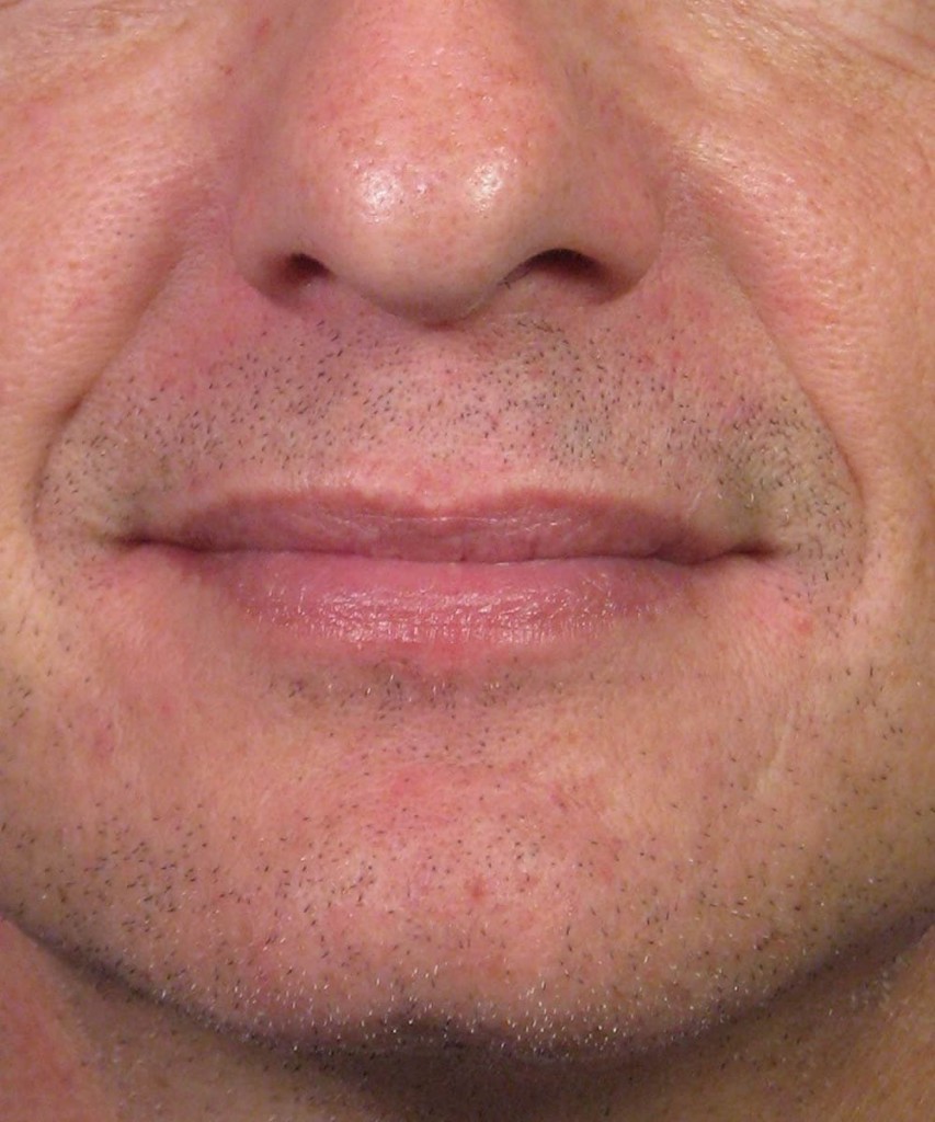 After front