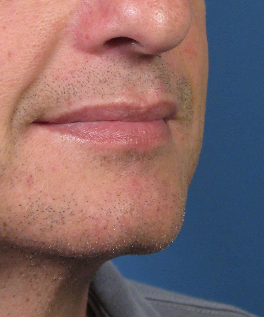 After diagram oblique