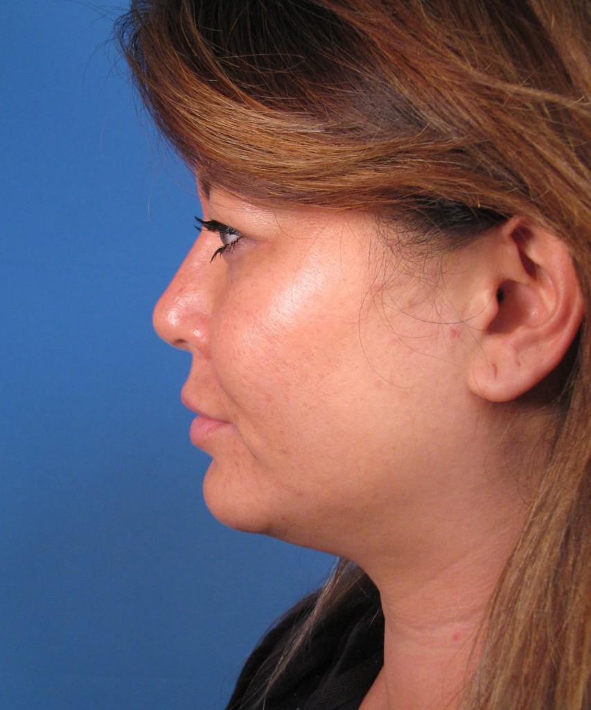 Before side