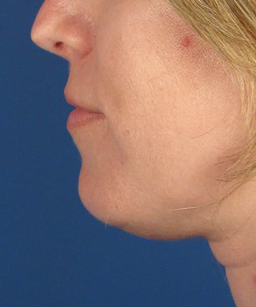 Before side