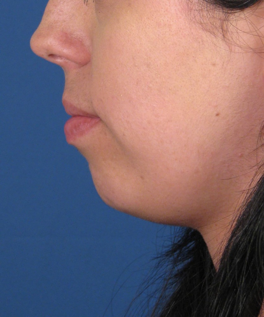 Before side