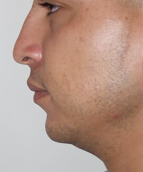 Before side