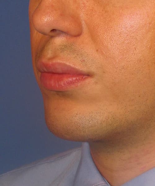 After angle