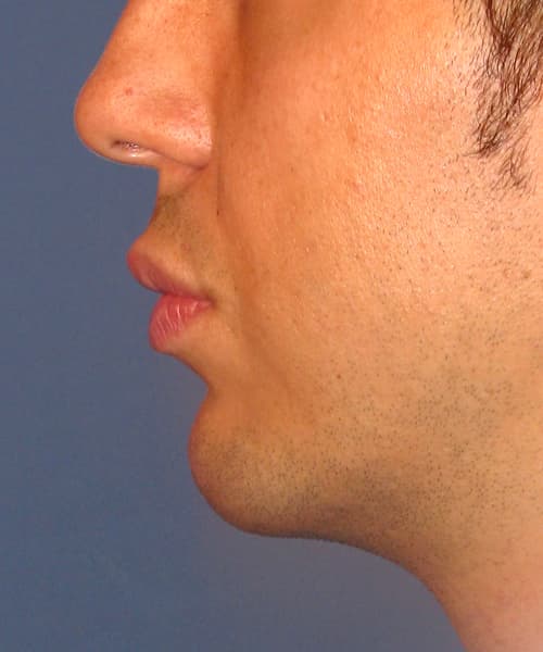 After side