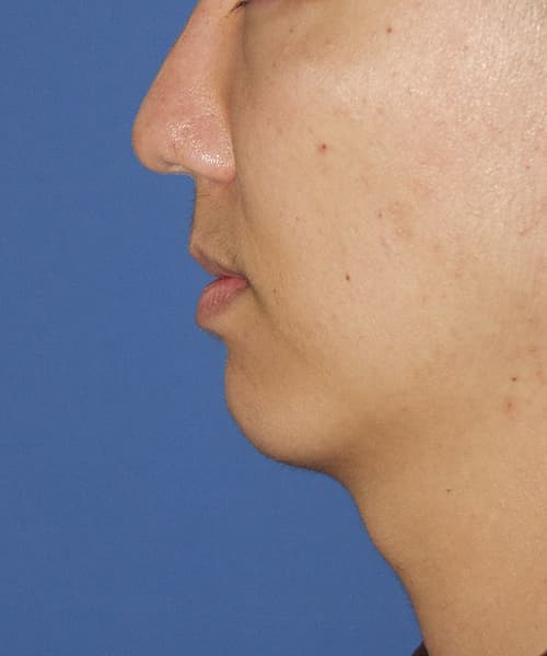 Before side