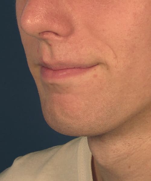 After angle