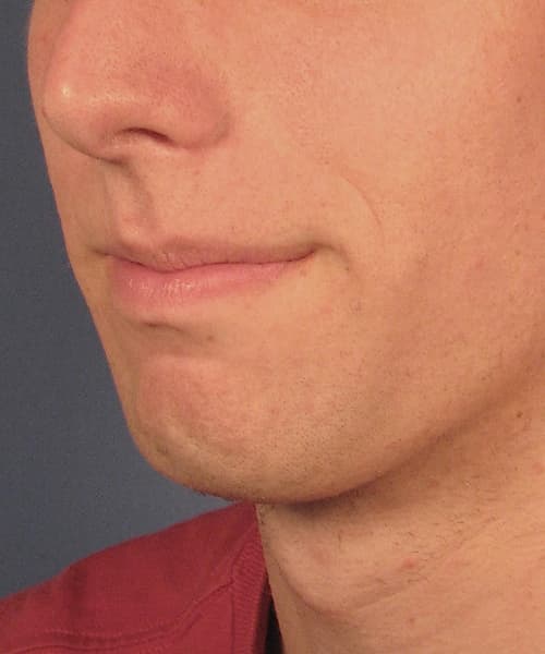 Before angle