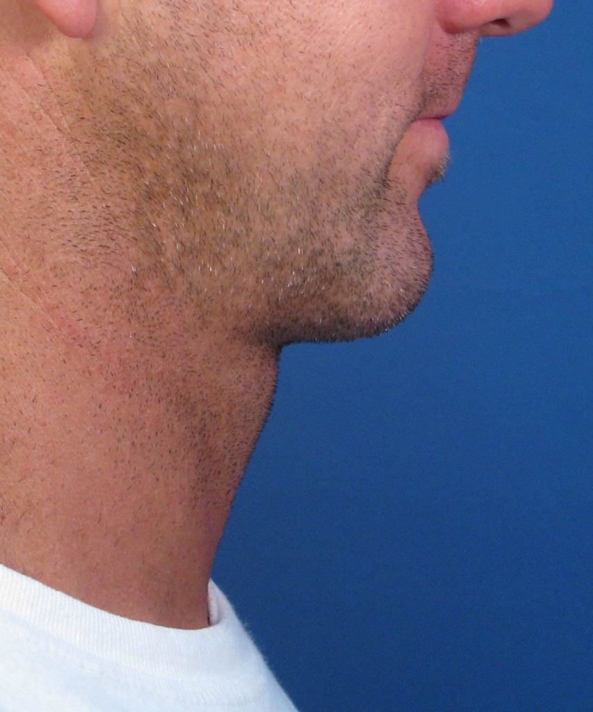 After lateral