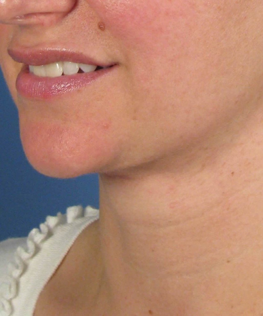 After oblique