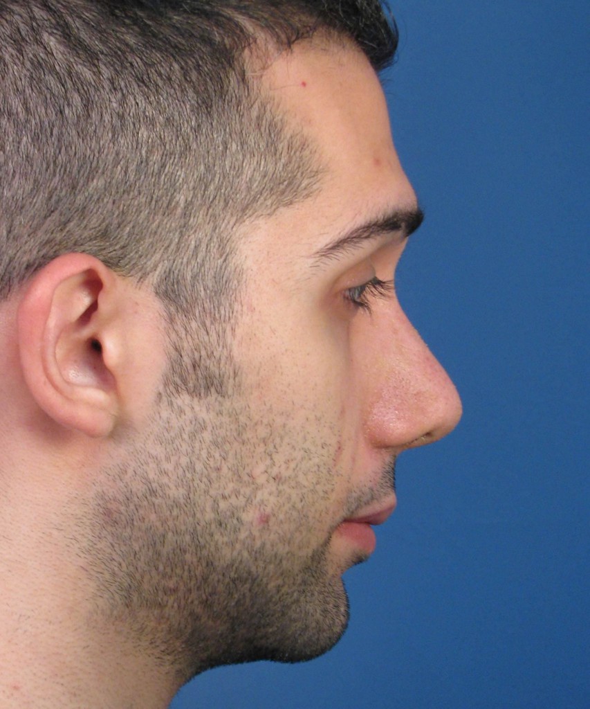 After lateral