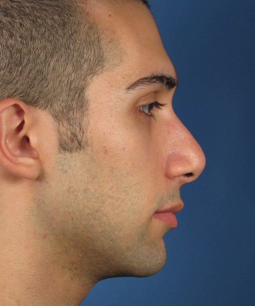Before lateral
