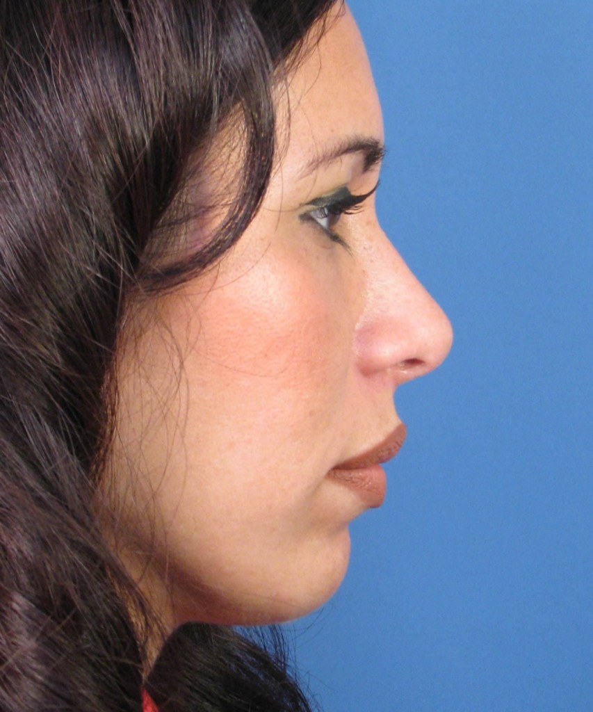 After lateral