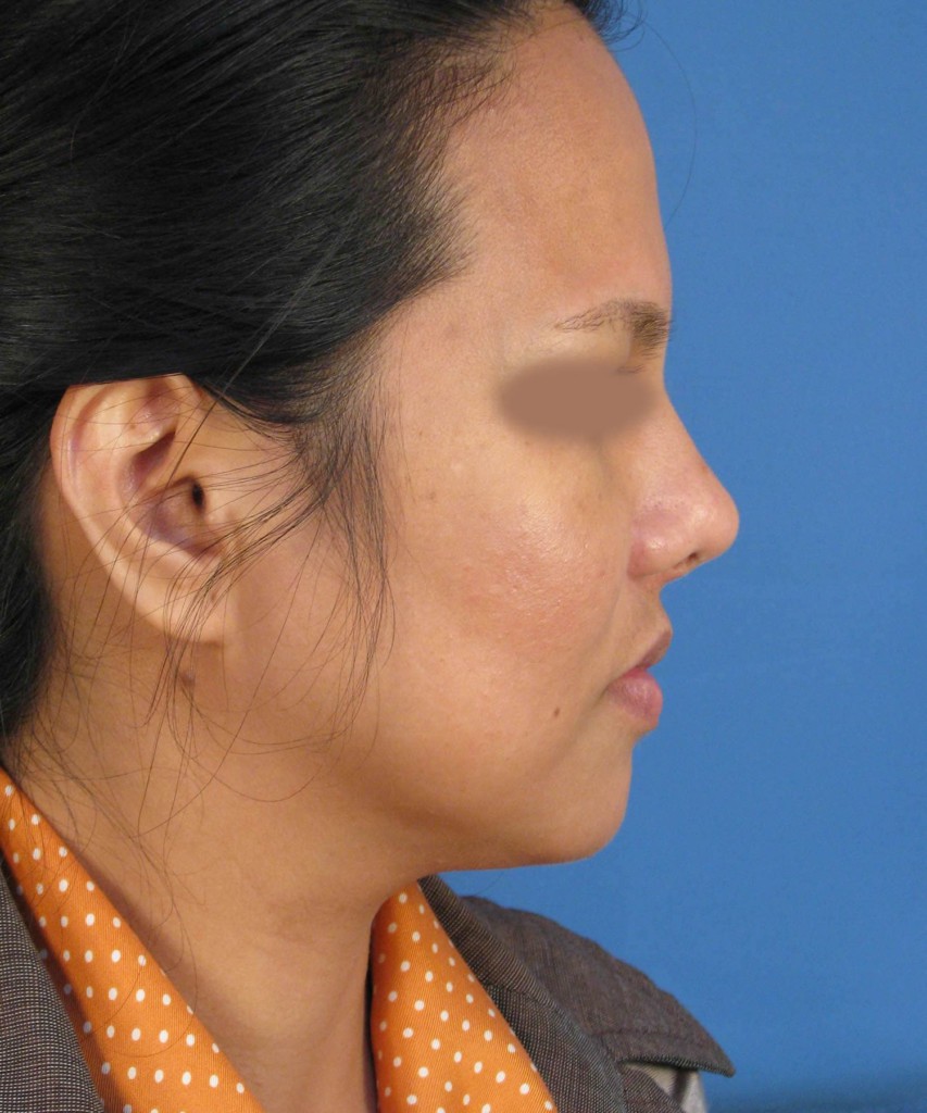 After lateral