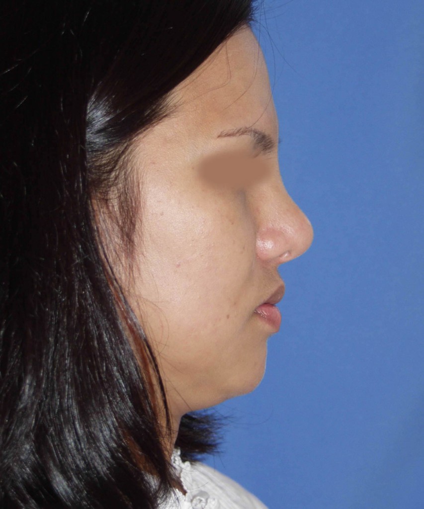 Before lateral