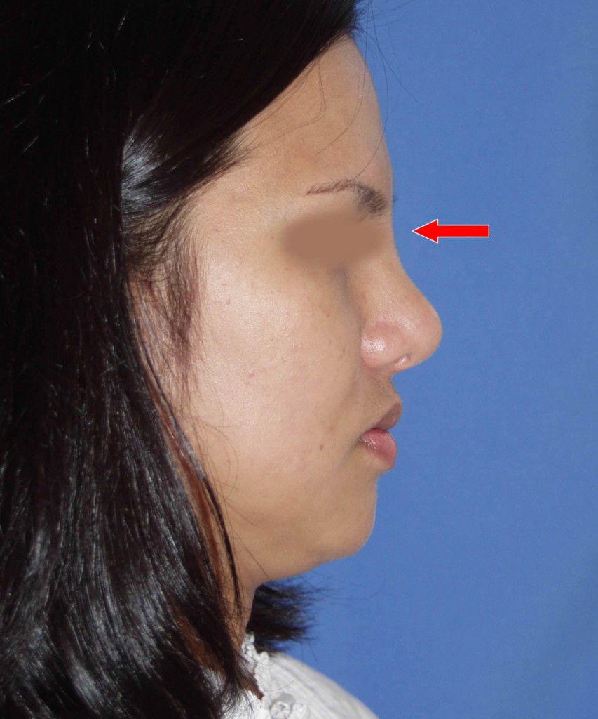 Before lateral diagram