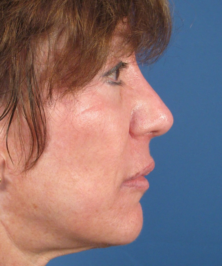 After lateral