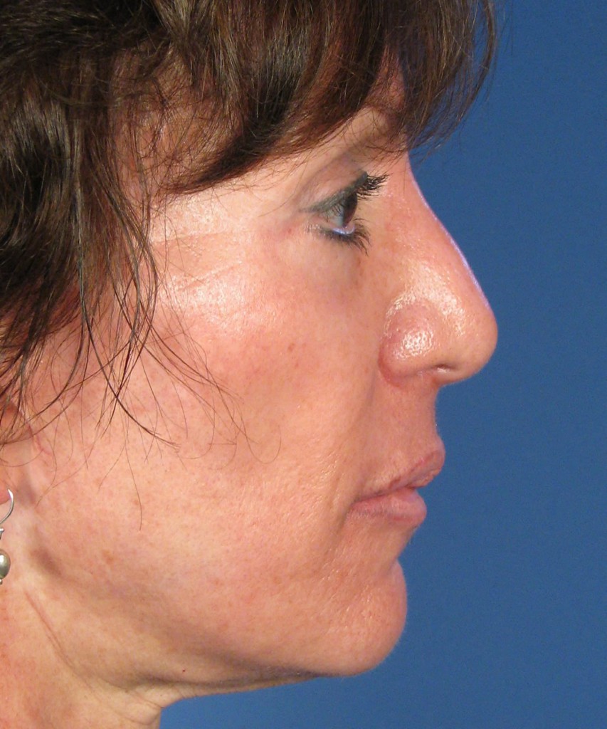 Before lateral