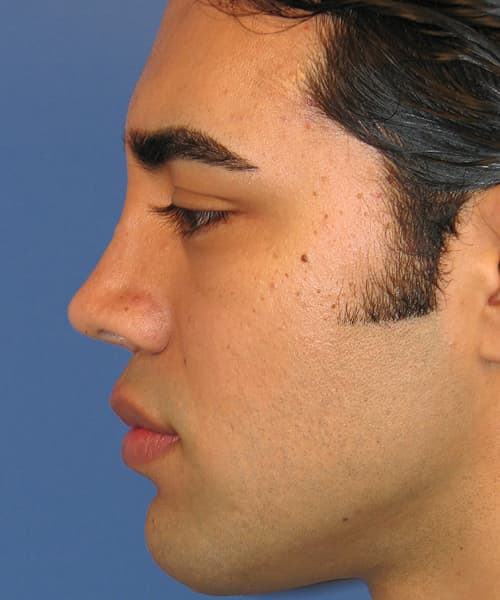 Before side left