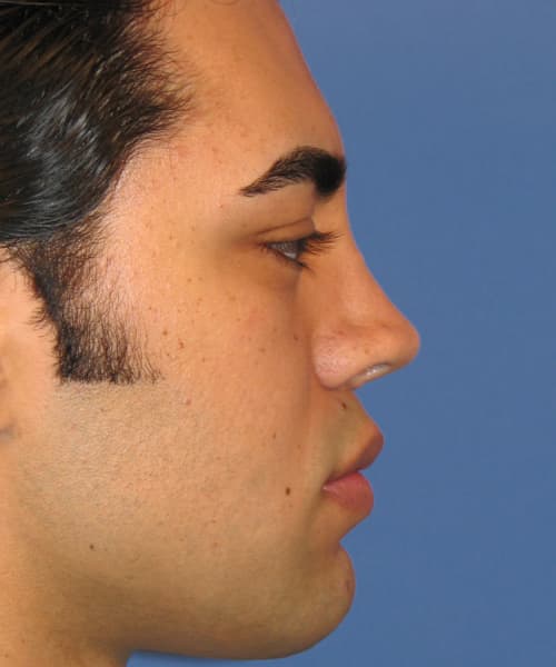 Before side right