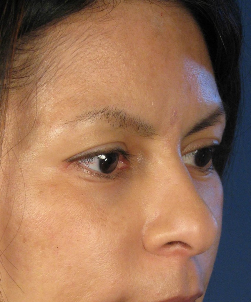 Before angle