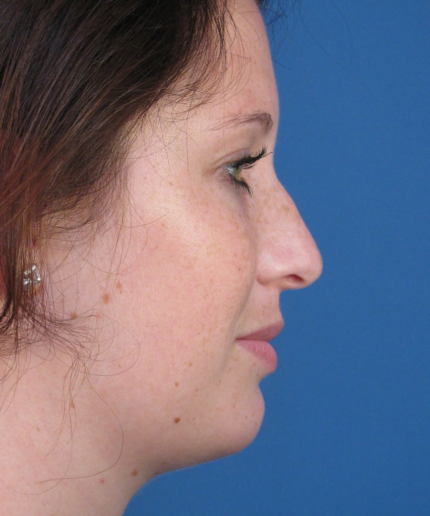 Before lateral