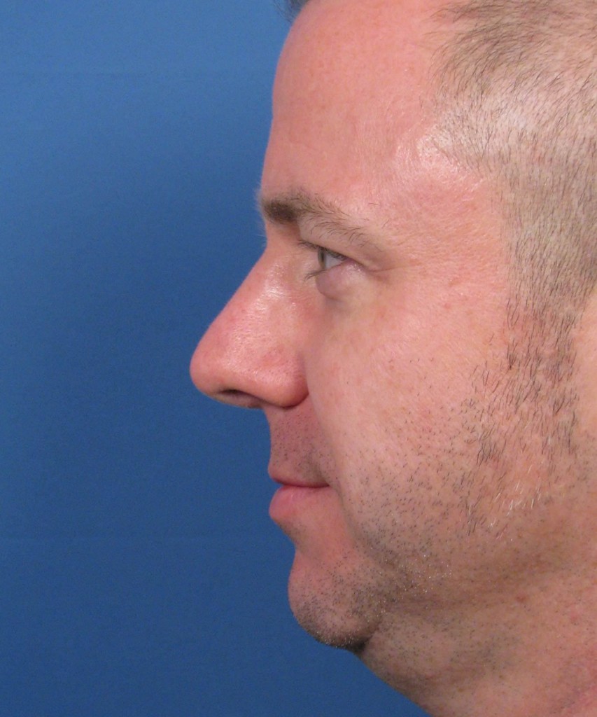 After lateral